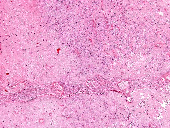 1A4 Aspergillus (Case 1) H&E 10X same area