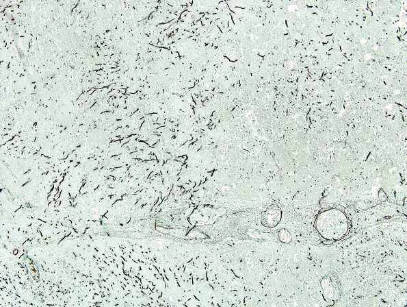 1A5 Aspergillus (Case 1) GMS 10X same area