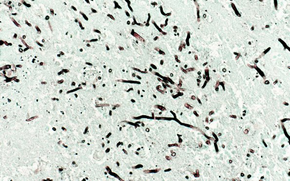 1A8 Aspergillus (Case 1) GMS 40X same area