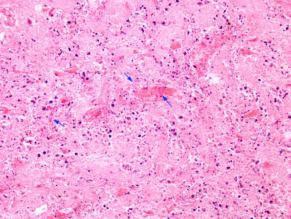 1A9 Aspergillus (Case 1) H&E 40X same area copy