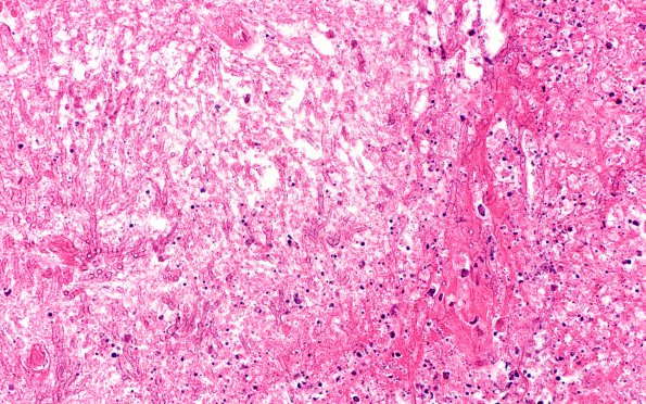 2A2 Aspergillosis (Case 2) H&E 40X