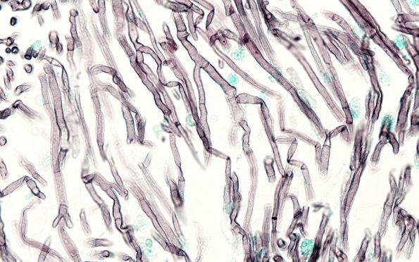 2A3 Aspergillus (Case 2) GMS 100X 2