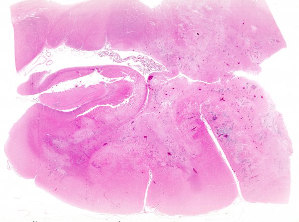 4A1 Aspergillosis (Case 4) H&E whole mount