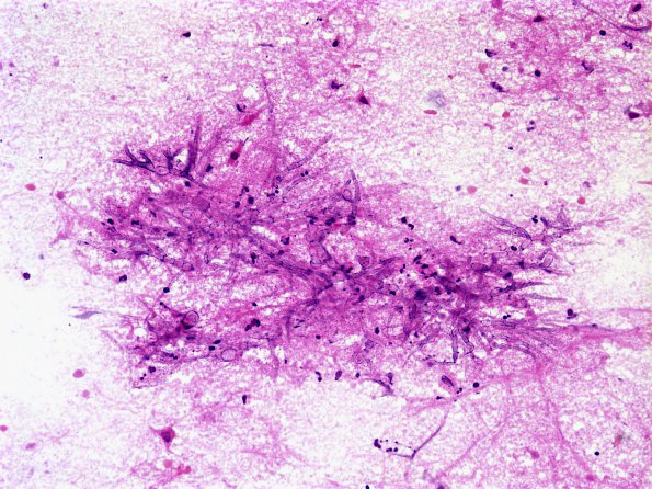 5 Aspergillus smear (Case 5)