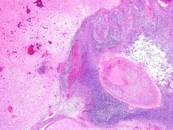 6A2 Aspergillosis (Case 6) H&E 4A