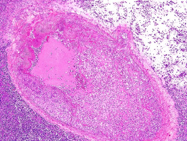 6A3 Aspergillosis (Case 6) H&E 2