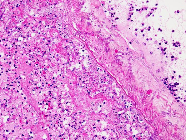 6A4 Aspergillosis (Case 6) H&E 1