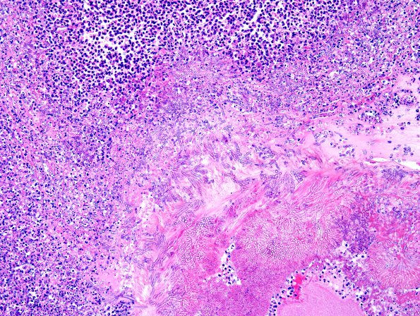 6A5 Aspergillosis (Case 6) H&E 5