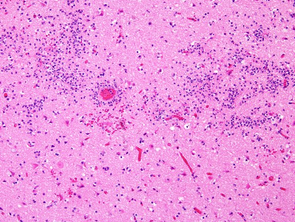 6A6 Aspergillosis (Case 6) H&E 3 (infarct area)