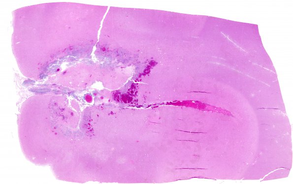 7A1 Aspergillosis (Case 7) H&E whole mount