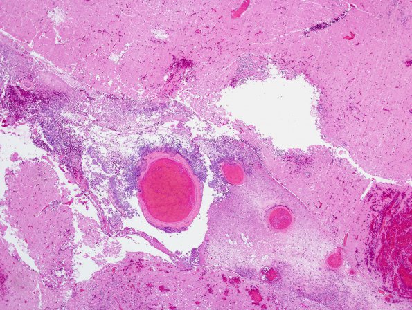 7A2 Aspergillosis (Case 7) H&E 3