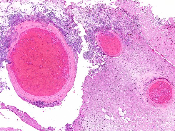 7A3 Aspergillosis (Case 7) H&E 4