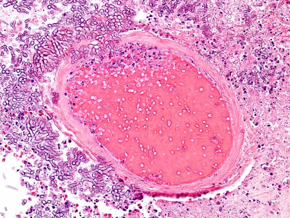 7A4 Aspergillosis (Case 7) H&E 2