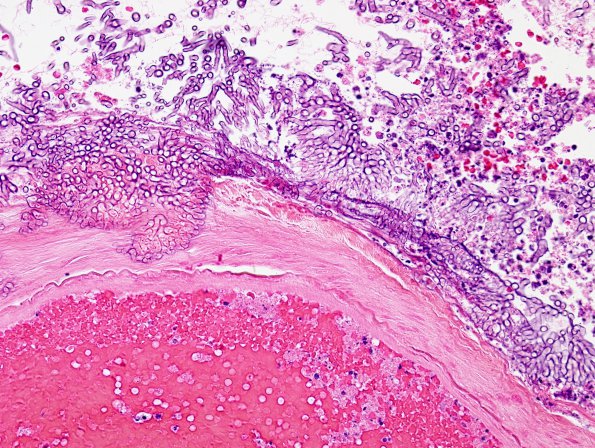 7A5 Aspergillosis (Case 7) H&E 1