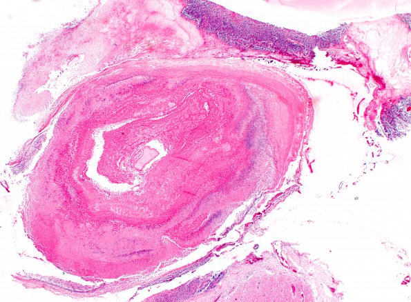 8A1 Abscess & Granuloma (Case 8) H&E 7