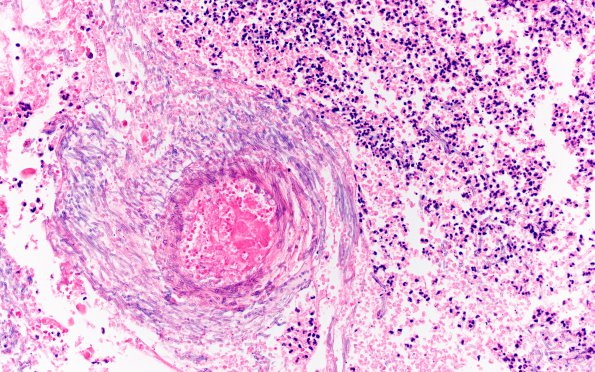 8A3 Abscess & Granuloma (Case 8) H&E 6