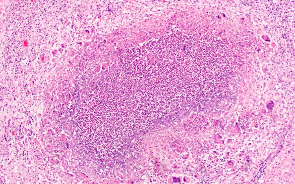 8A5 Abscess & Granuloma (Case 8) H&E 2