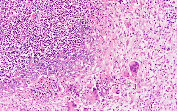 8A6 Abscess & Granuloma (Case 8) H&E 1