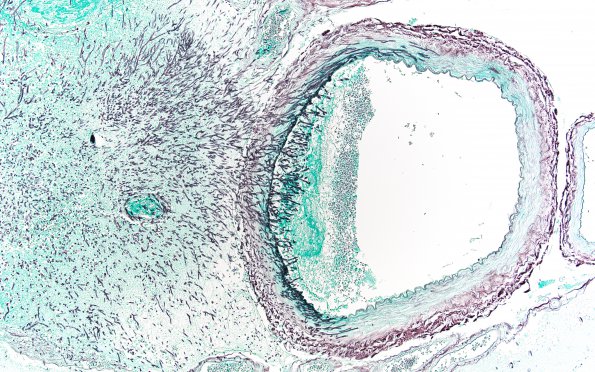 9 Aspergillosis (Case 9) GMS 40X