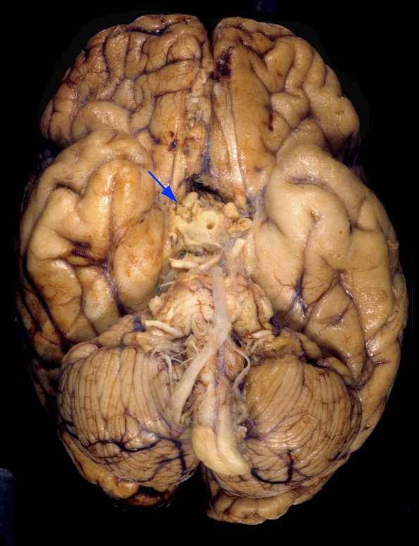 1A1 Aspergillus, sinusitis, vasculitis and infarct (Case 1) 4 copy