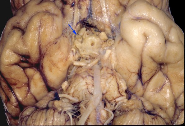 1A2 Aspergillus, sinusitis, vasculitis and infarct (Case 1) 1 copy