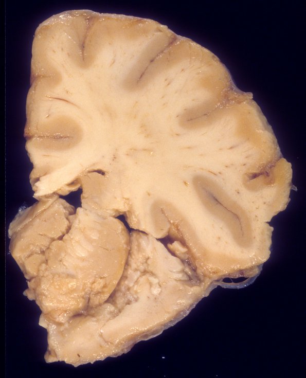 1A3 Aspergillus, sinusitis, vasculitis and infarct (Case 1) 4