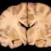 1A4 Aspergillus, sinusitis, vasculitis and infarct (Case 1) 6A copy