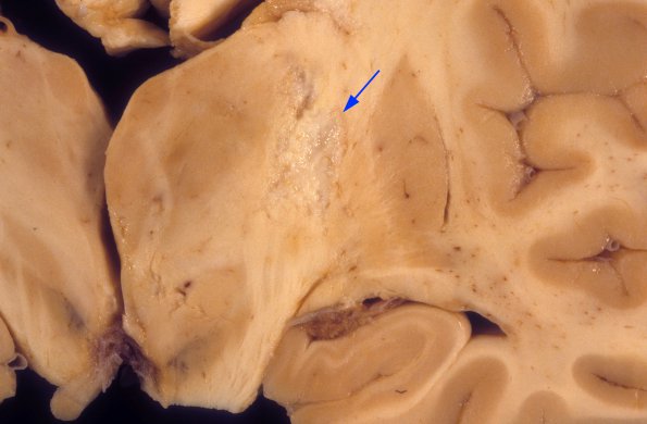 1A5 Aspergillus, sinusitis, vasculitis and infarct (Case 1) 1 copy