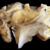 1A7 Aspergillus, sinusitis, vasculitis and infarct (Case 1) 7 copy