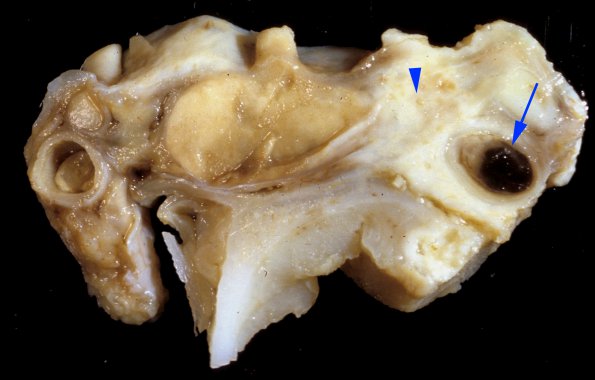 1A7 Aspergillus, sinusitis, vasculitis and infarct (Case 1) 7 copy