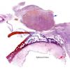 1B1 Aspergillus, sinusitis, vasculitis and infarct (Case 1) AB PAS OG copy copy