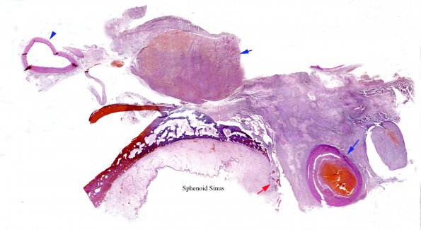 1B1 Aspergillus, sinusitis, vasculitis and infarct (Case 1) AB PAS OG copy copy