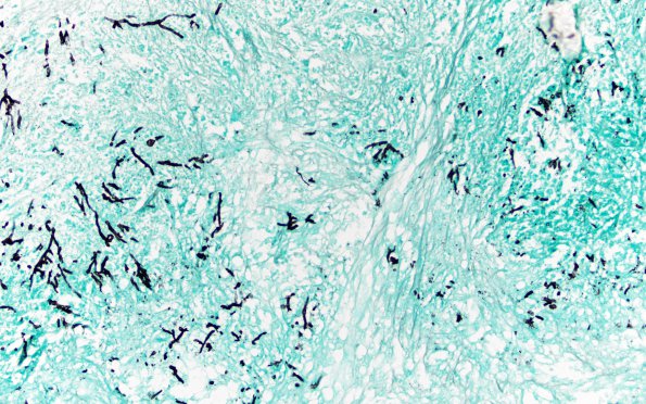 1B4 Aspergillus, sinusitis, vasculitis and infarct (Case 1) GMS sphenoid wall 1