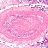 1B8 Aspergillus, sinusitis, vasculitis and infarct (Case 1) N11 H&E 1