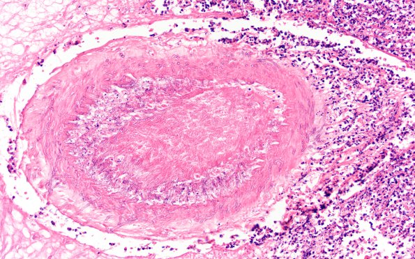 1B8 Aspergillus, sinusitis, vasculitis and infarct (Case 1) N11 H&E 1