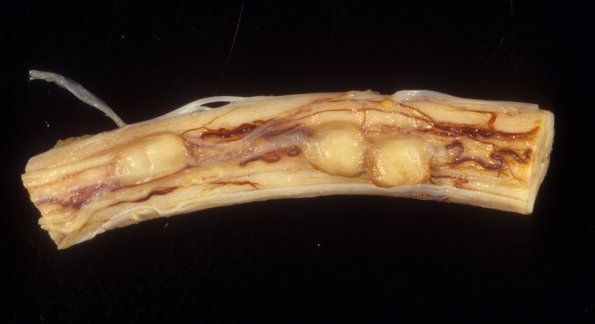 2A Aspergillus, vasculitis, spinal cord (Case 2) 1