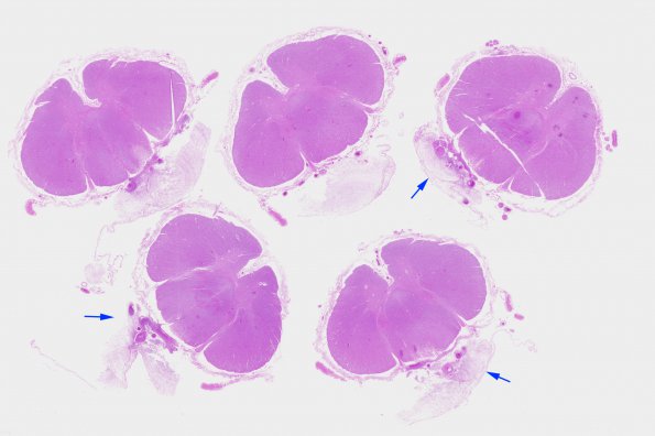 2B1 Aspergillus, vasculitis, not toothpaste effect (Case 2) N10 H&E whole mount A copy