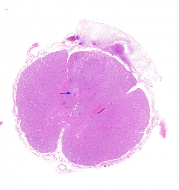 2B2 Aspergillus, vasculitis, spinal cord (Case 2) N10 H&E whole mount copy