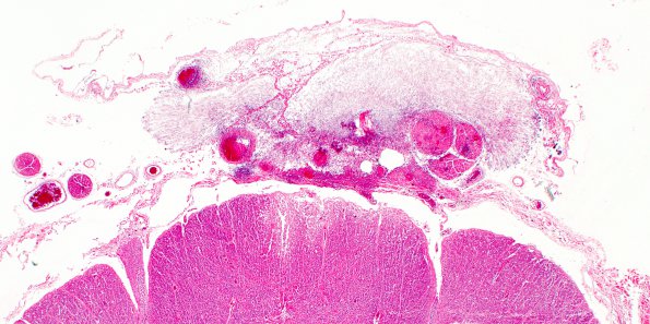 2B3 Aspergillus, vasculitis, spinal cord (Case 2) N10 H&E 2X