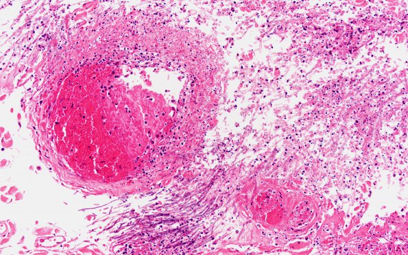 2B6 Aspergillus, vasculitis, spinal cord (Case 2) N10 H&E 20X 2