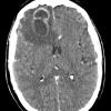 3A Aspergillosis (Case 3) sinusitis CT 2 - Copy - Copy