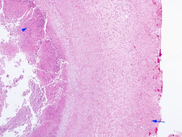 3B2 Aspergillosis (Case 3) H&E 4 copy