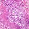 3B3 Aspergillosis (Case 3) H&E 1