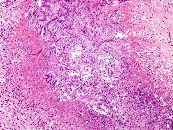 3B3 Aspergillosis (Case 3) H&E 1