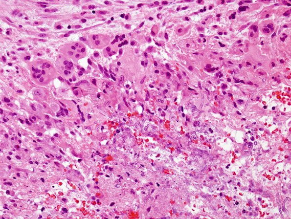 3B4 Aspergillosis (Case 3) H&E 5