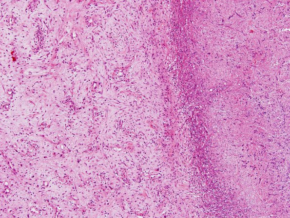 3B5 Aspergillosis (Case 3) H&E 2