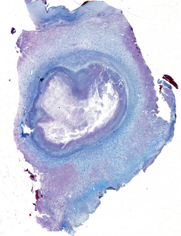 3C3 Aspergillosis (Case 3) Trichrome whole mount