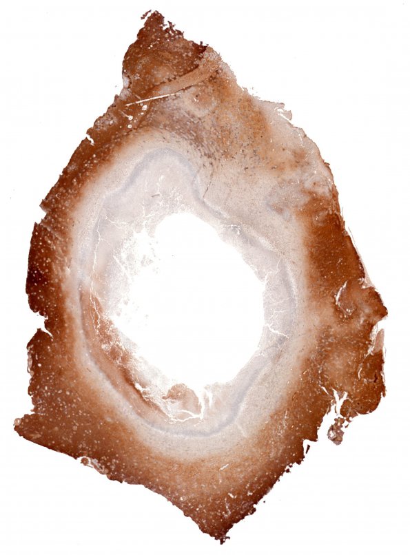 3C6 Aspergillosis (Case 3) GFAP whole mount