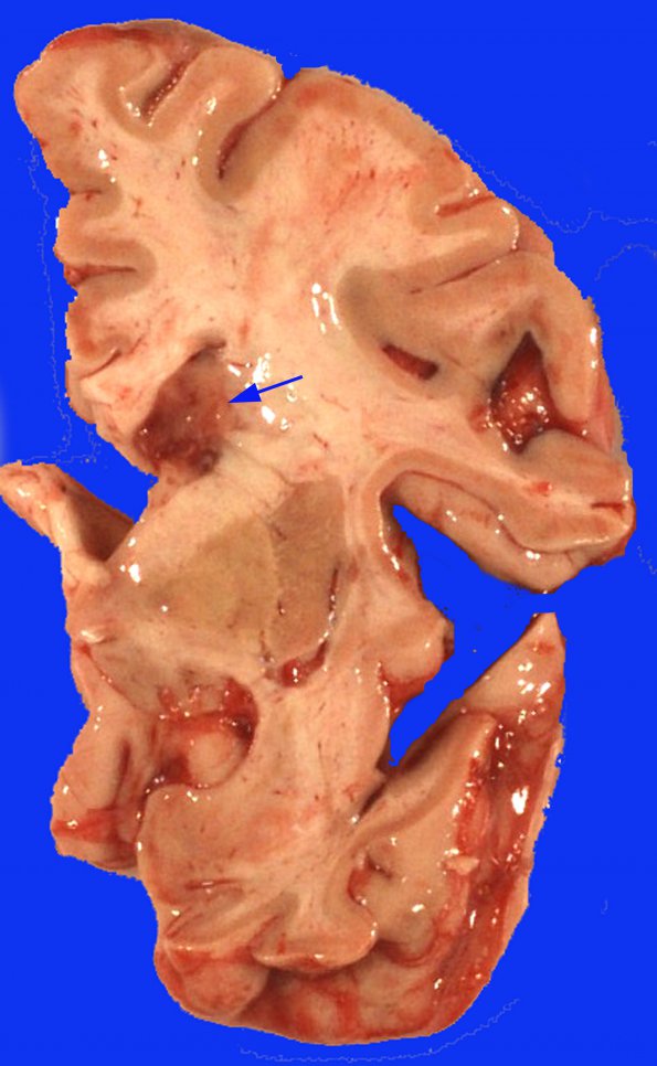 4A Aspergillus, unsuspected & AD (Case 4) 2 copy