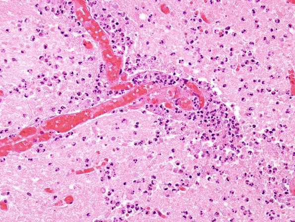 4B2 Aspergillus, unsuspected & AD (Case 4) H&E 12